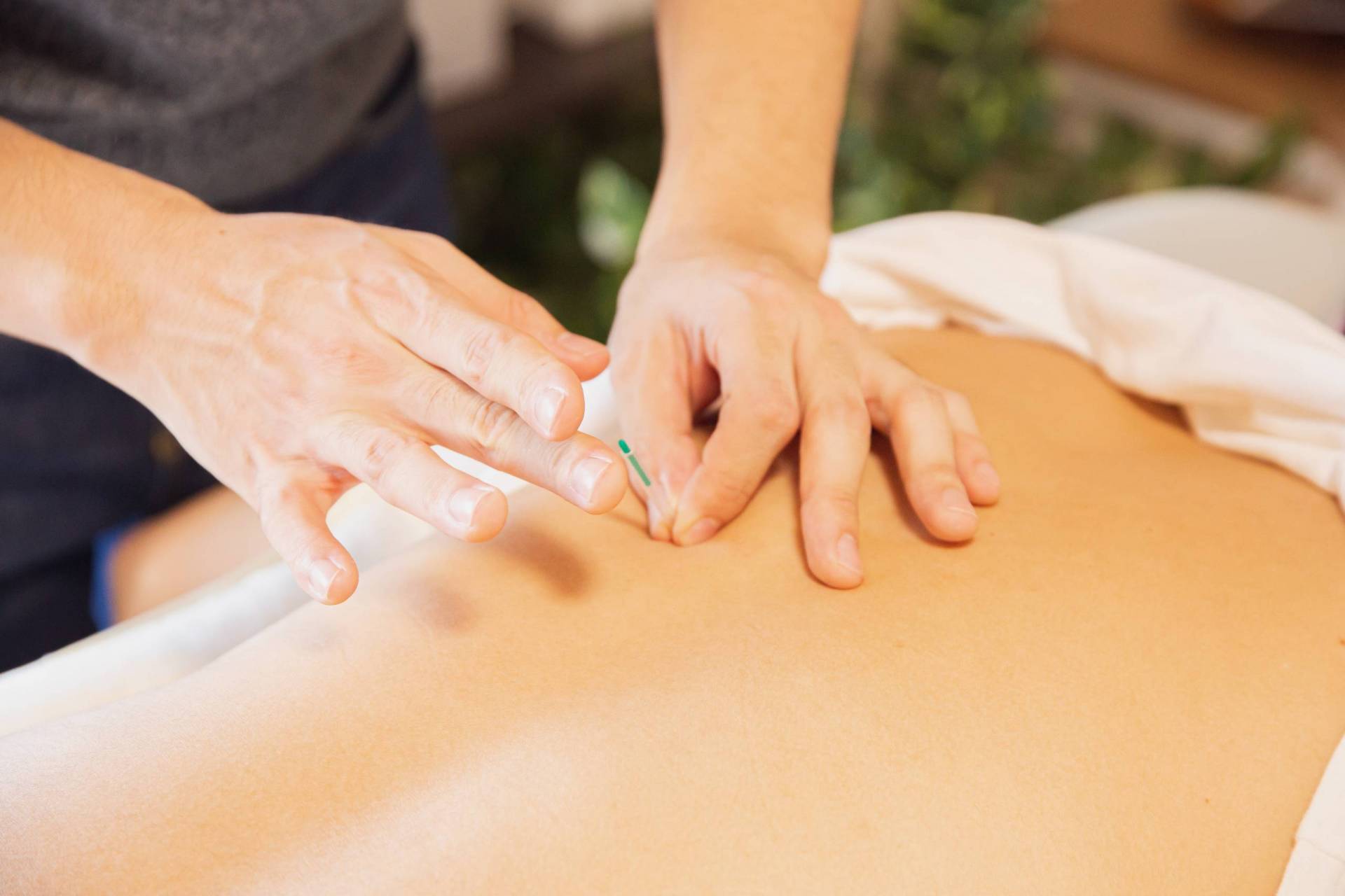 Deep-dry needling (“modern acupuncture”)